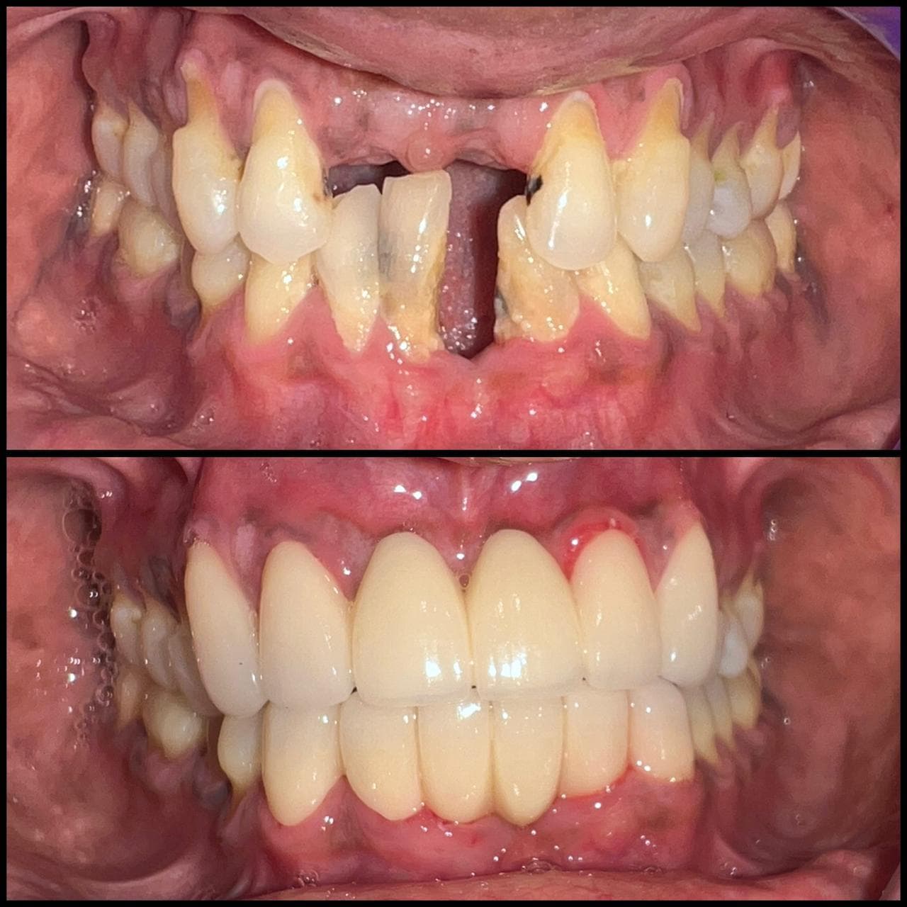 Dental Restoration