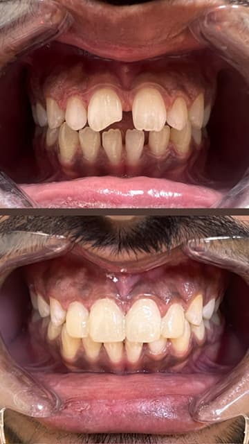 Smile Makeover